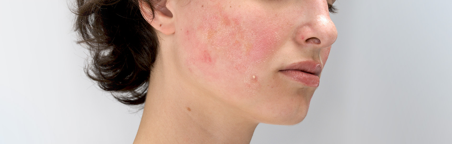 Dry and shop acne prone skin