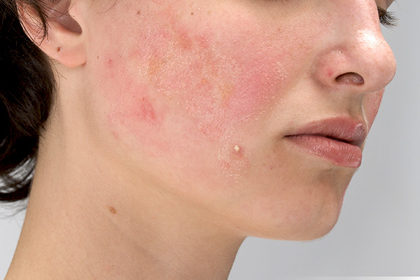 Dry Skin Acne Causes and Treatments CeraVe