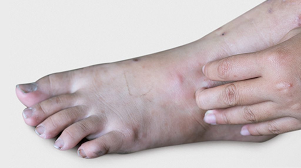 Diabetic foot dryness cheap