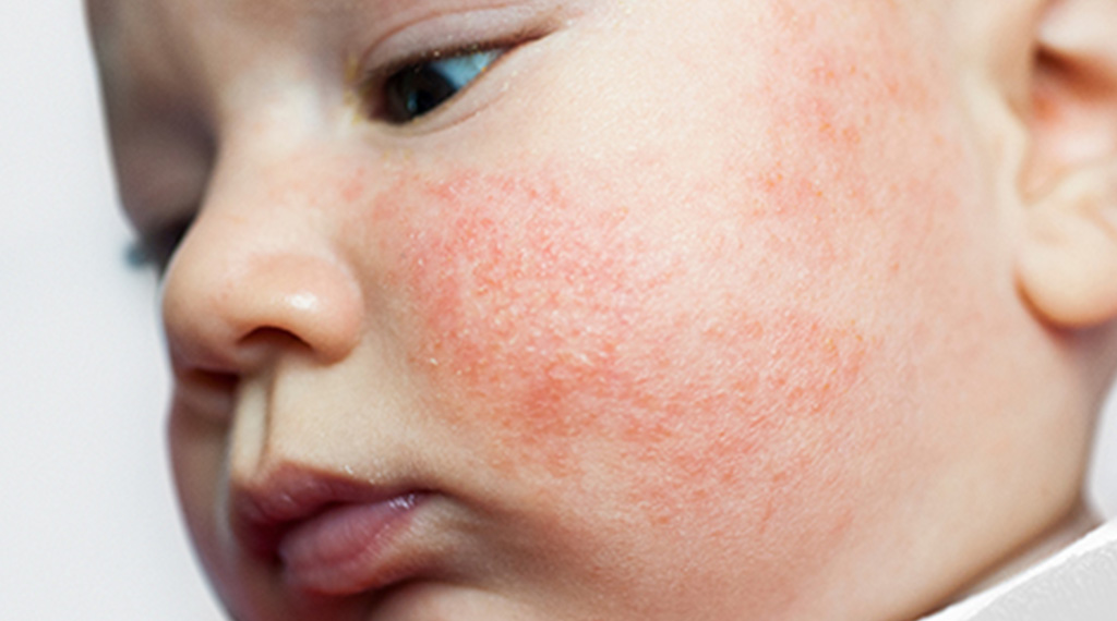 Seborrhea baby face treatment online