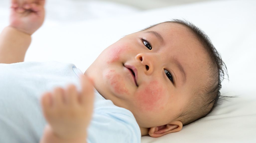 Common Baby Rashes | CeraVe