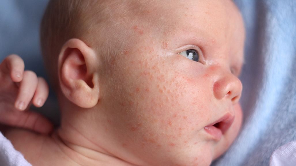 Baby shop acne cream