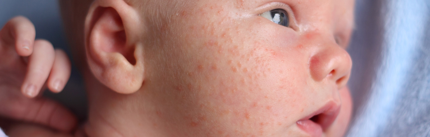 Infant acne discount