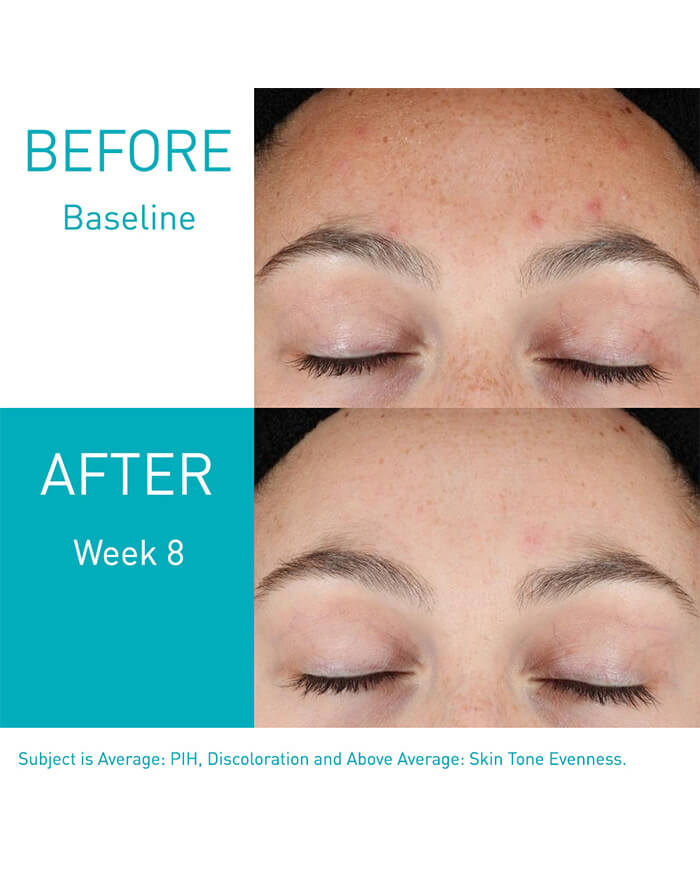 Stå sammen Indvending hypotese Resurfacing Retinol Serum | Post-Acne Marks Treatment | CeraVe