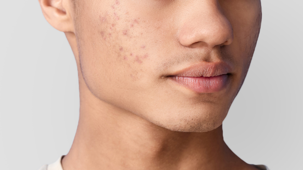 Face wash sale for teenage acne