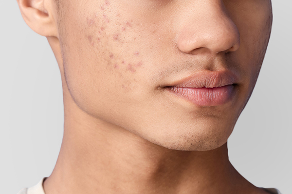 Understanding Acne and skincare Solutions CeraVe