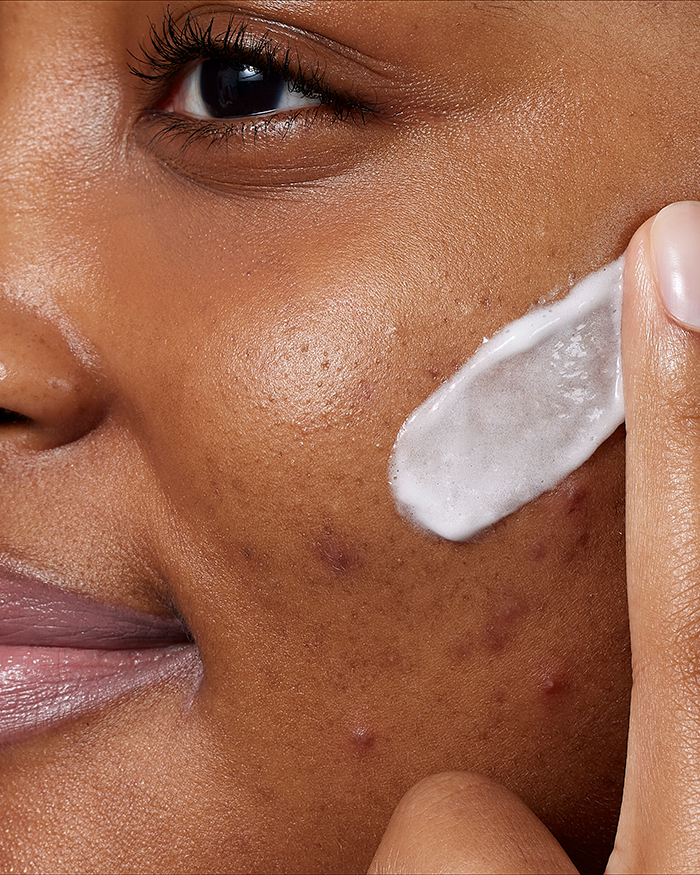 Acne Foaming Cream Wash 10 Benzoyl Peroxide CeraVe